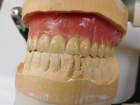 Efficiency and Accuracy in Denture Base Processing - Figure 1